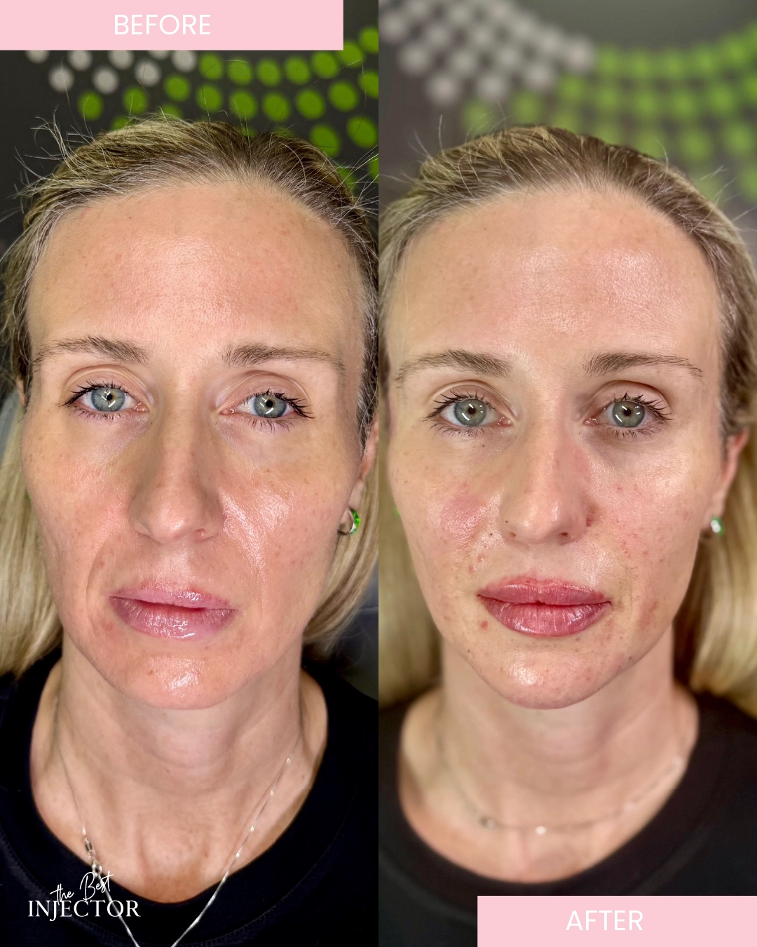 chin and jawline facial balancing Delray Beach B-A