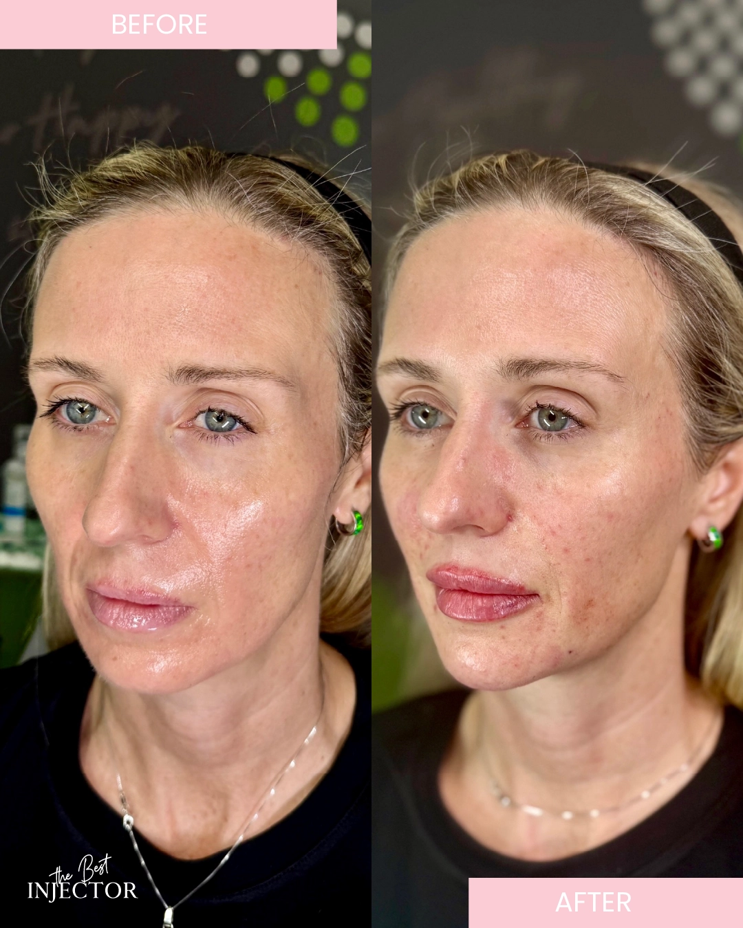 chin and jawline facial balancing Delray Beach B A