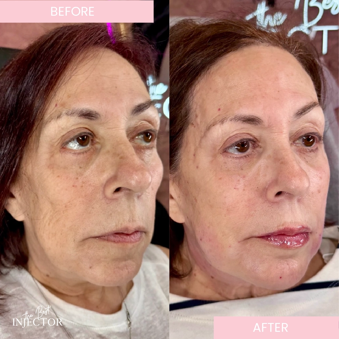chin and jawline facial balancing Delray Beach