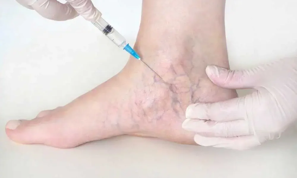 Sclerotherapy in Delray Beach, FL by The Best Injector