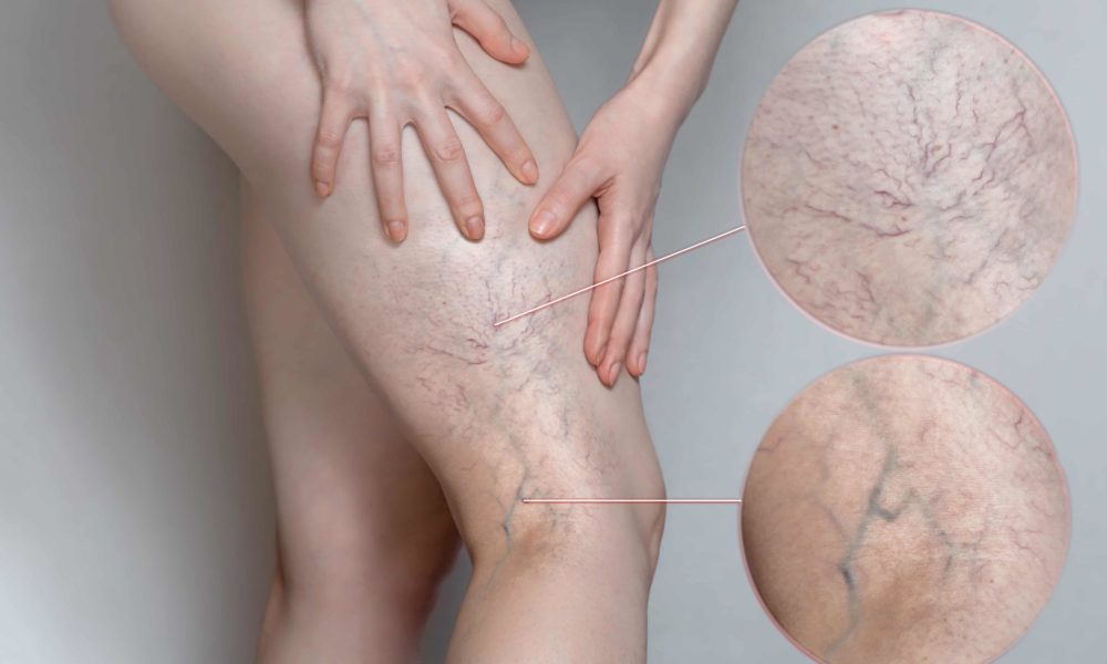 Why Sclerotherapy Might Be Right for You