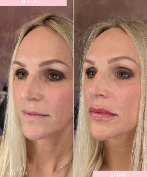 Natural lip filler before and after Delray Beach