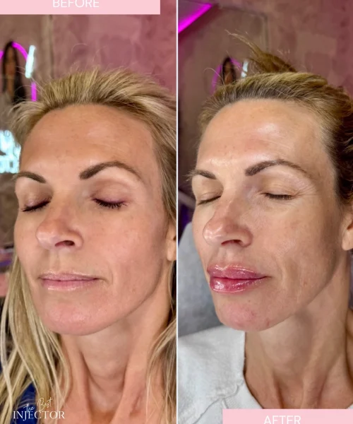 Natural lip filler before and after Delray Beach