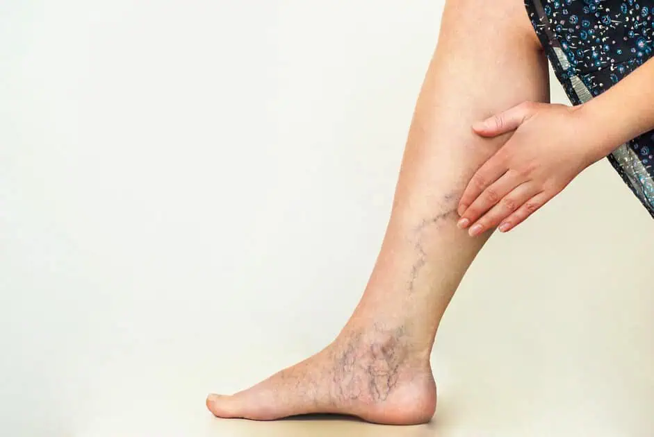 Sclerotherapy, Spider Veins, Sclerotherapy for leg veins, Non-surgical spider vein treatment